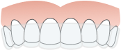 graphic of teeth with Invisalign Aligners