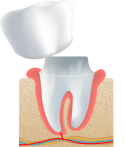 graphic of veneers and crown
