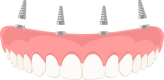 Denture Implants graphic